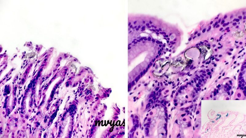 Hierro y desarrollo cognitivo infantil: la evidencia global